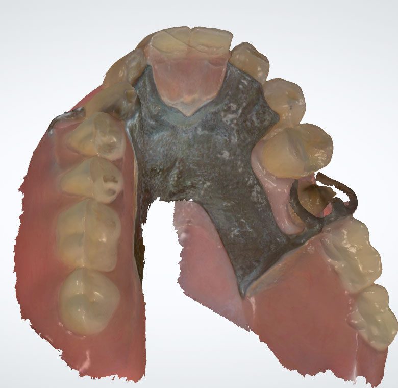 Upper partial denture with metal palatal framework