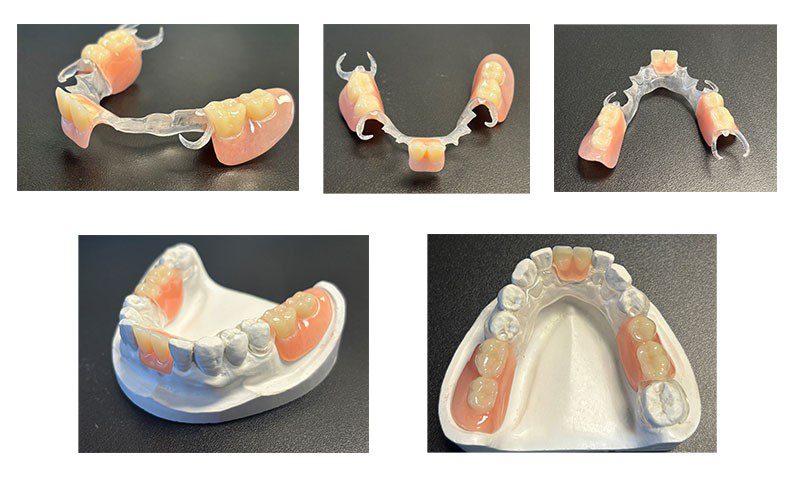 Removable clear flexible partial dentures