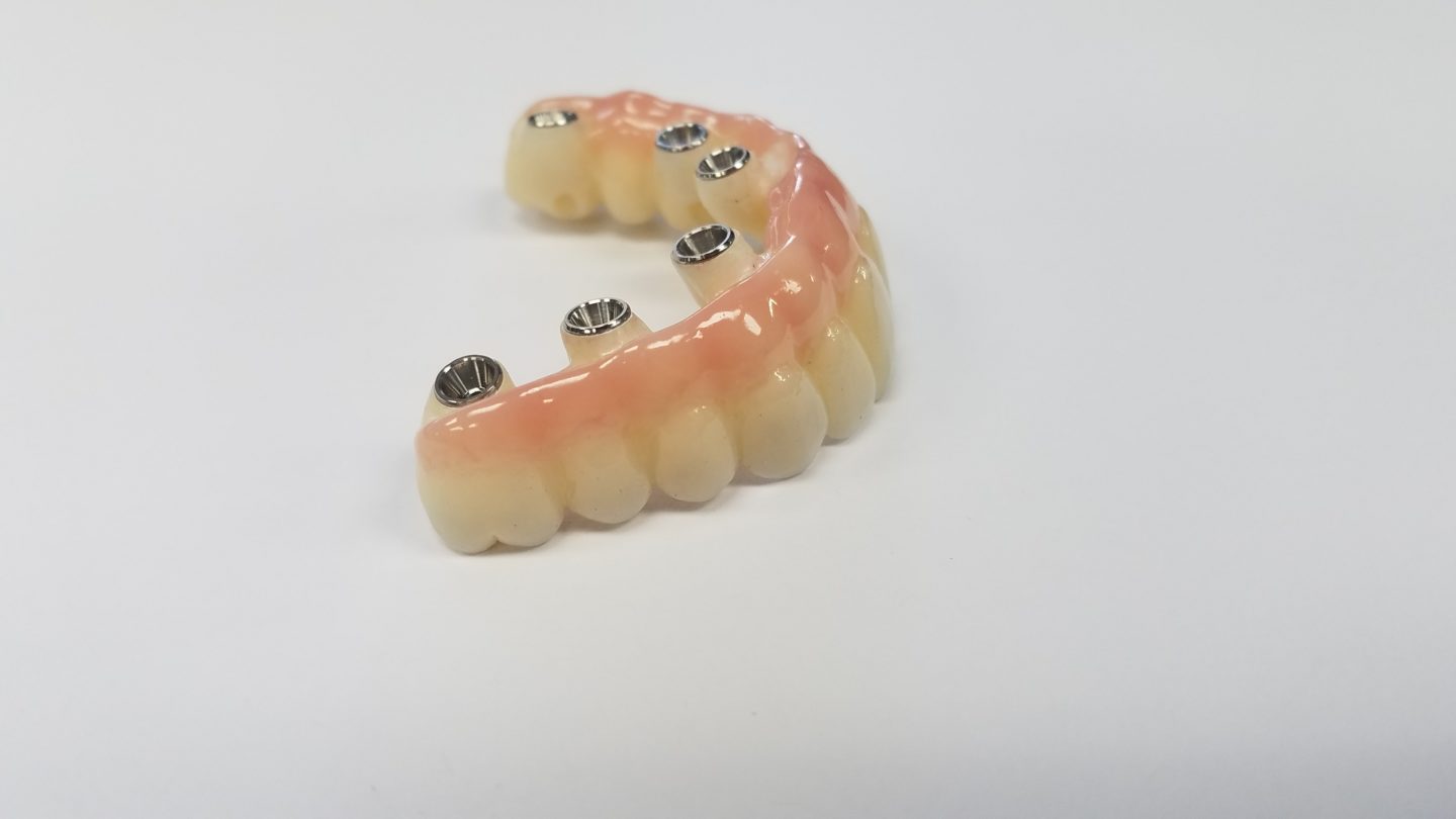 Implant-supported denture with metal abutments