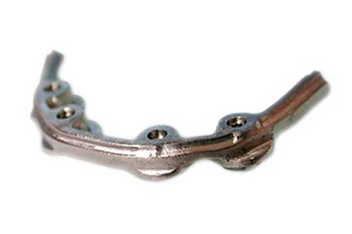 Curved metal jaw bone plate with screw holes