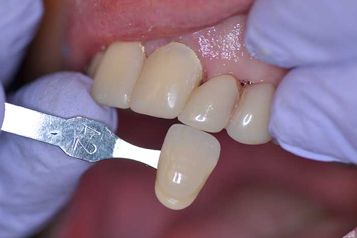 Dental shade guide held against front teeth