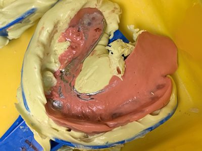 Lower dental impression with pink and yellow material