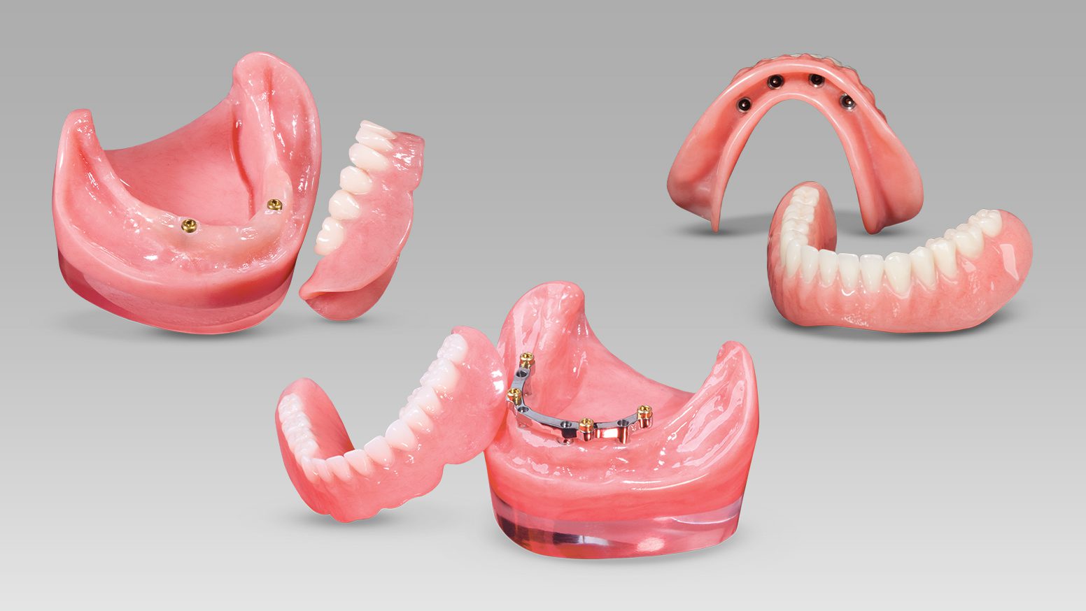 Multiple implant-supported dentures and dental prostheses
