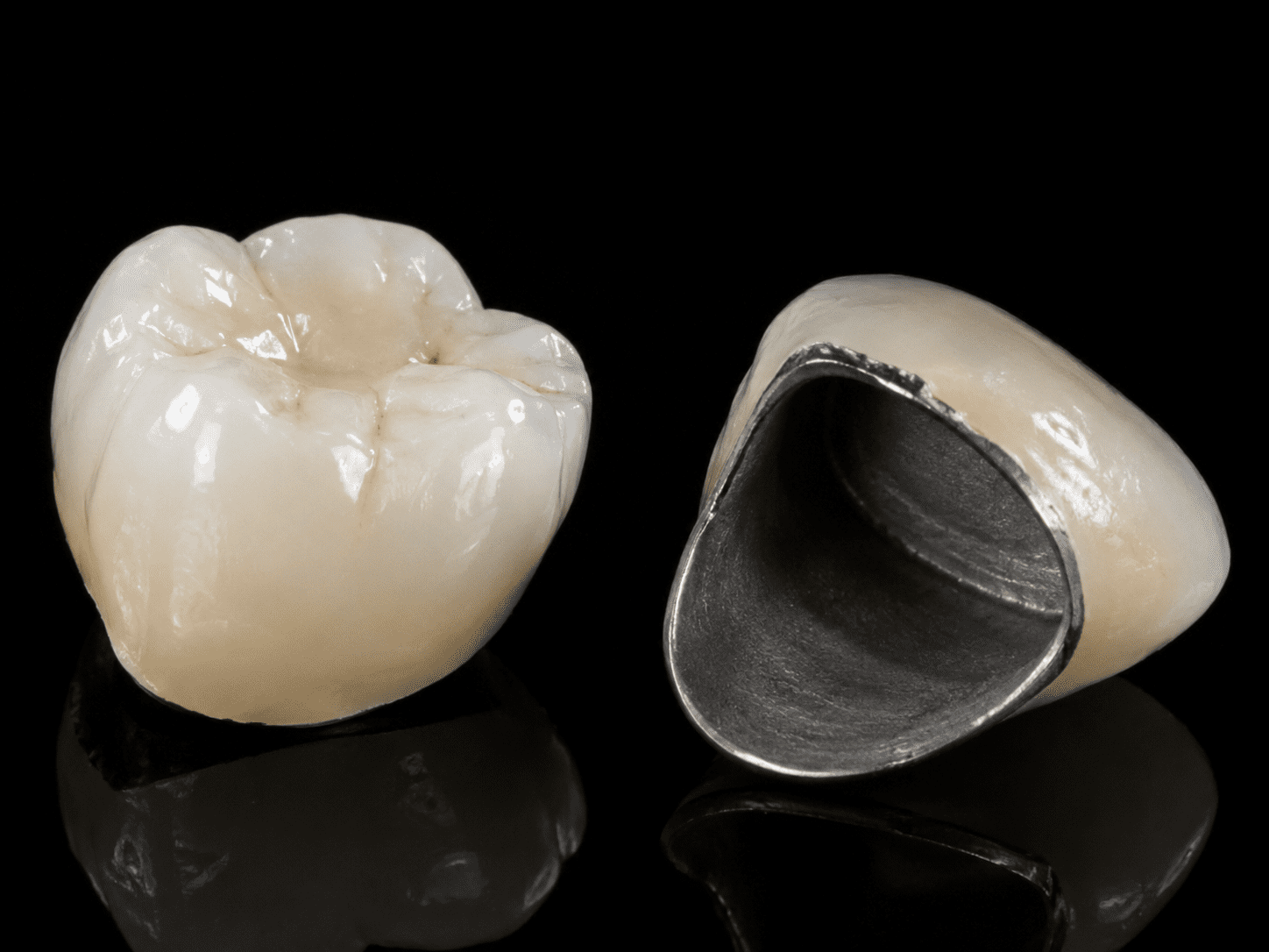 Porcelain-fused-to-metal dental crowns