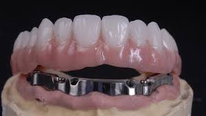 Upper implant-supported denture with metal bar