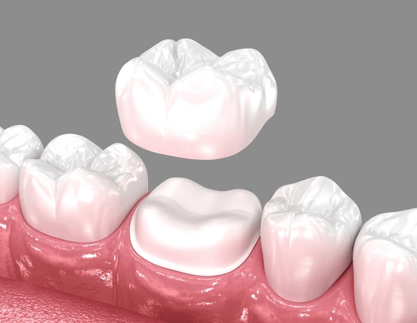 Dental crown being placed on molar