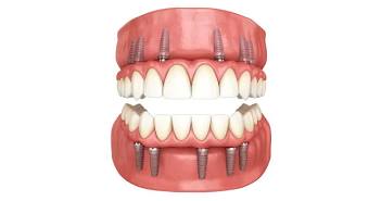 Upper and lower implant-supported dentures
